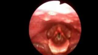 Flexible Video Stroboscopy Exam Kansas Voice Center [upl. by Kelula]