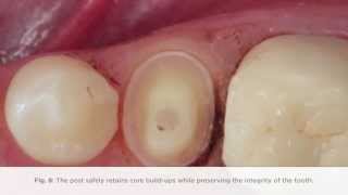 How to complete a post procedure using FibreKleer 4x Fiber Posts [upl. by Adall270]