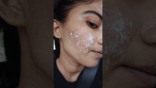 Transforming My Skin  Acne Scars Journey Laser Treatment skincare shorts [upl. by Leinod]