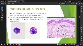 Acute dermatosis [upl. by Collie]