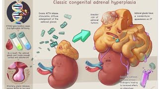 Congenital Adrenal Hyperplasia  Causes Clinical presentation Diagnosis and Treatment [upl. by Ettinger]