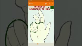 Position of Benediction of Hand UPPER LIMB ANATOMY lumbricalsinjury [upl. by Balliol]