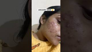 How I cleared my Acne  Acne journey  Get rid of acne  Adult Acne  Products that helped me [upl. by Nailij]