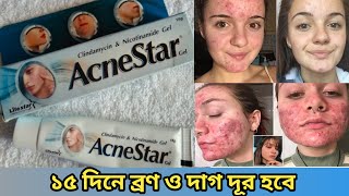 Acnestar gel review Acnestar gel Acne start gel for acne amp pimple skin AcneStar Moriom Akter Mim [upl. by Halona]