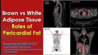 Brown vs White Adipose Tissue Roles of Pericardial Fat [upl. by Inotna910]