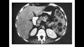 Pneumocystis carinii Abszesse in der Milz [upl. by Wisnicki]