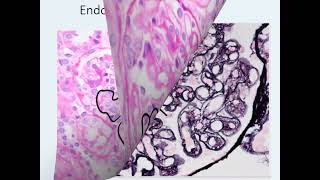 شرح عربي Membranoproliferative Glomerulonephritis Practical session [upl. by Leohcin]