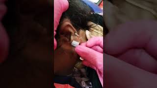 Non surgical Ear lobe treatment  painless  Earlobe 😍 [upl. by Enoryt199]