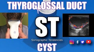 Sonoquickie Thyroglossal Duct Cyst [upl. by Rehpitsirhc]