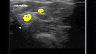 C5C6 cervical nerve root blocks [upl. by Niuqaoj]