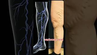 Varicose veins and treatment [upl. by Aisya]