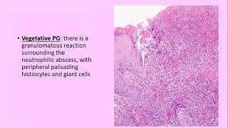 Lecture99 Neutrophilic Dermatoses Pyoderma Gangrenosum amp Sweets syndrome PartI Rooks Ch 49 [upl. by Drarig]