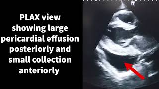 Pericardial effusion [upl. by Nole]