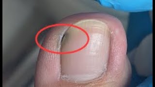 Nails are not cleaned properly and dirt is hidden [upl. by Drue]