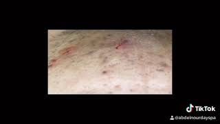 Long ingrown hair removal video Mix Watch me extract some cool ingrowns with a lancetamp my hands [upl. by Ahsienet]