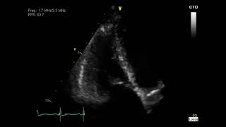 Carcinoid Syndrome [upl. by Hanschen]