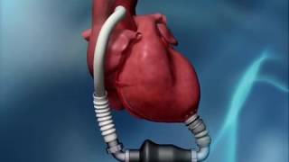 HeartMate II LVAD Animation [upl. by Dorri293]