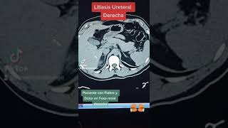 Litiasis ureteral derecha [upl. by Egnalos]