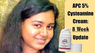 APC 5 Cysteamine Cyspera Dupe 8 Week Update on Melasma [upl. by Thury]