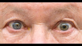 Anisocoria  Symptoms and Causes  Diagnosis  Treatment  Prevention [upl. by Anyd]