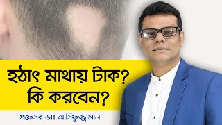 Alopecia Areata Treatment Bangla  Androgenetic Alopecia Treatment  হঠাৎ মাথায় টাক [upl. by Milty]