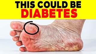 ALERT 18 SIGNS of DIABETES on THE SKIN that FEW PEOPLE KNOW  110 [upl. by Nerraj]