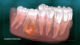 Dental Abcess  Why Root Canal Treatment Is Needed [upl. by Boy556]