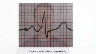 ECG PR Interval [upl. by Notnyw832]