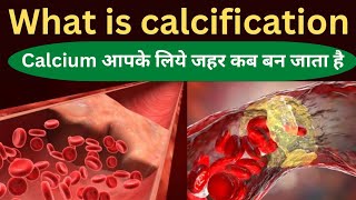 calcificationcalcification kya hota haicalcification in hindi calcification in brain [upl. by Sitelc]