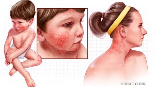 Mayo Clinic Minute Eczema occurs in people of all ages [upl. by Bryna]