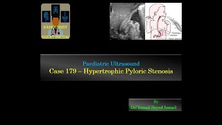 Ultrasound Case 179  Hypertrophic Pyloric Stenosis HPS [upl. by Kirtley549]