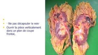 UROLOGIE Anatomie Pathologie du Rein [upl. by Anitsirhc788]