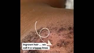 Ingrown hair on chin [upl. by Freya]