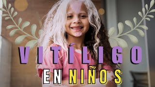 Manchas blancas en la piel de los niños  Vitiligo en Niños [upl. by Adler894]