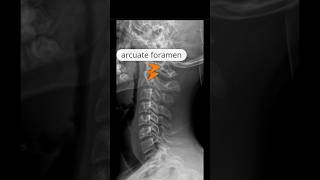 Bilateral arcuate foramen xray [upl. by Amorette561]