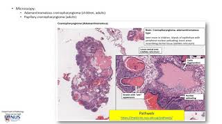 Brain Craniopharyngioma suprasellar tumour [upl. by Pollux]