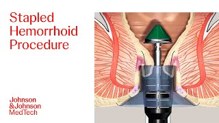 PPH Procedure Animation  Stapled Hemorrhoid Surgery  JampJ MedTech [upl. by Olmsted]