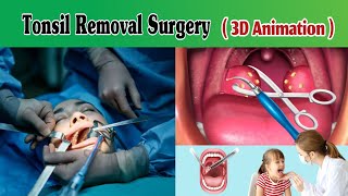 Tonsillectomy Surgery 3D Animation  Tonsillitis Surgery  Tonsils Operation [upl. by Broderick]