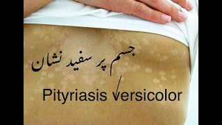 Pityriasis versicolor  جسم پر سفید نشان  funagal infection on skin DrHussainsharafat [upl. by Hodosh]