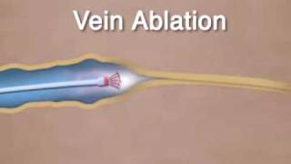 Varicose Vein Ablation amp Closure [upl. by Krebs]