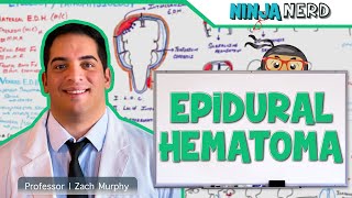 Epidural Hematoma  Anatomy Etiology Pathophysiology Clinical Features Treatment [upl. by Hakan44]