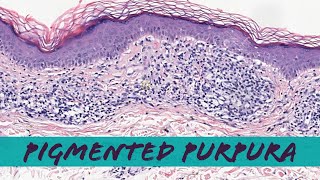 Pigmented Purpuric Dermatosis Schamberg disease lichen aureus etc pathology dermatology [upl. by Oirramed]