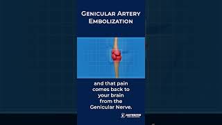 Block Pain Sensations — Genicular Artery Embolization [upl. by Sutniuq918]