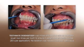 Desensitizing Procedure using the NEW TEETHMATE DESENSITIZER from Kuraray [upl. by Seiuqram]