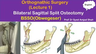 Obwegeser  BSSO  Bilateral Sagittal Split Osteotomy  Orthognathic Surgery  Syed Amjad Shah [upl. by Mark]