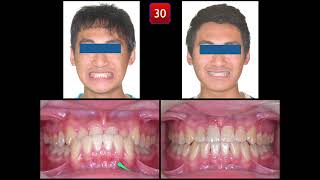 Solving Class III Malocclusion with Anterior Crossbite｜【Chris Chang Ortho】CC723 [upl. by Garrity]