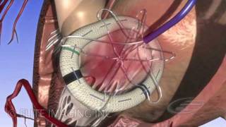 Mitral Heart Valve Ring  Medical amp Scientific Video Production [upl. by Eelan]