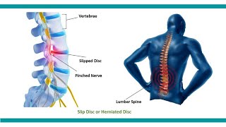 Back bone shilp disc L4 L5S1 kamar dard bina surgery ke 101 ilaaj physiotherapy se Dr AP GAUTAM [upl. by Tranquada]