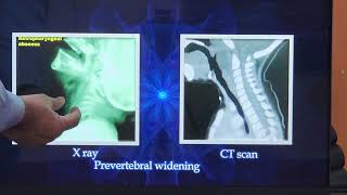 Acute Retropharyngeal Abscess  Tamil  Patient teaching programme [upl. by Dan577]