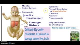 What causes galactosemia  Symptoms Types Genetic Testing Treatment Diet Safe food USMLE NCLEX 3 Mn [upl. by Leacock]